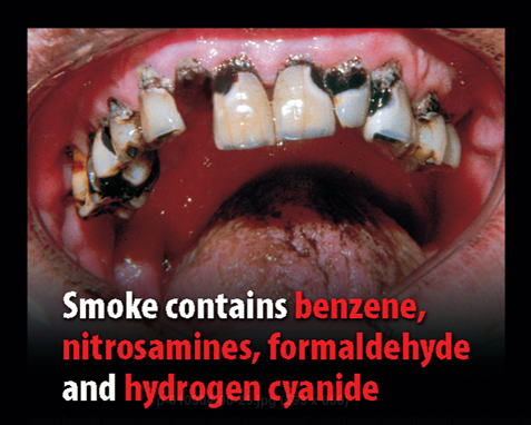 Rauchen schützt (nicht nur) vor Parodontitis